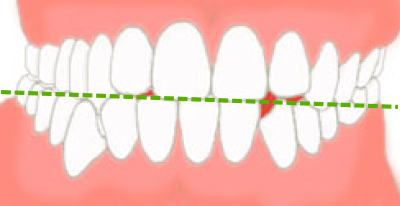 顎の偏位画像