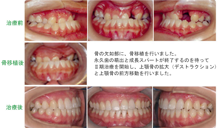 骨の欠如部に、骨移植を行いました。 永久歯の萌出と成長スパートが終了するのを待って Ⅱ期治療を開始し、上顎骨の拡大（デストラクション） と上顎骨の前方移動を行いました。