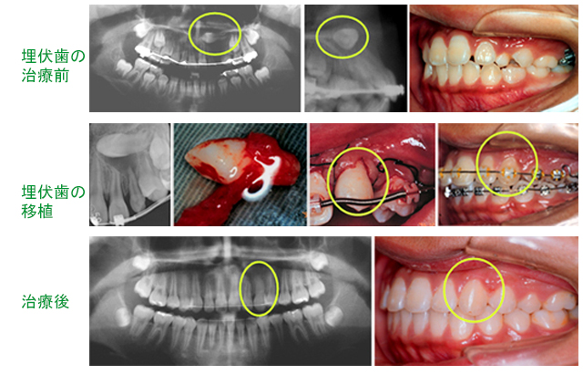 矯正歯科治療と歯牙移植を併用したケース