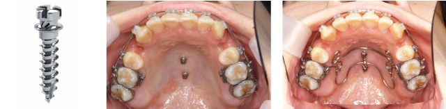 歯科矯正用アンカースクリュー