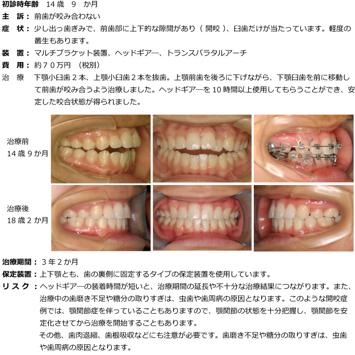 開咬