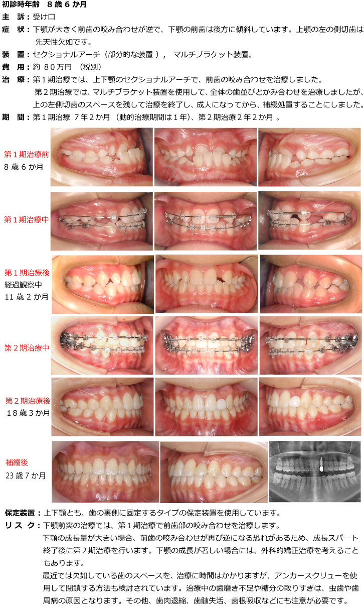 小臼歯を抜かない（非抜歯）で治療した症例
