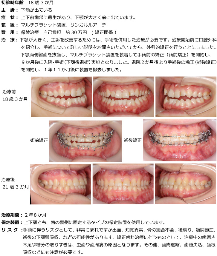 小臼歯を抜かない（非抜歯）で治療した症例