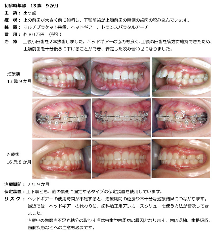 出っ歯（上顎前突）